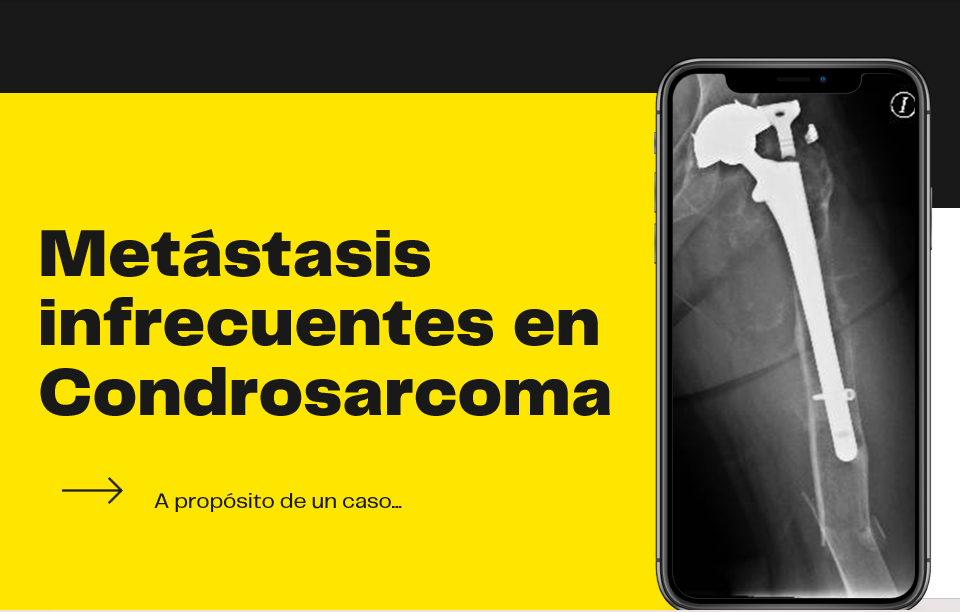EP139 Metástasis infrecuentes de condrosarcoma